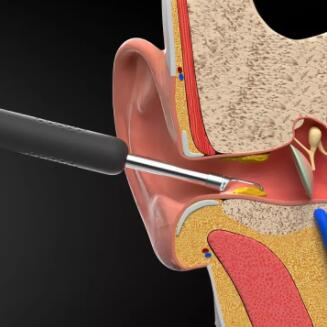 黑蜂智造bebird M9 Pro智能可视耳勺采耳棒